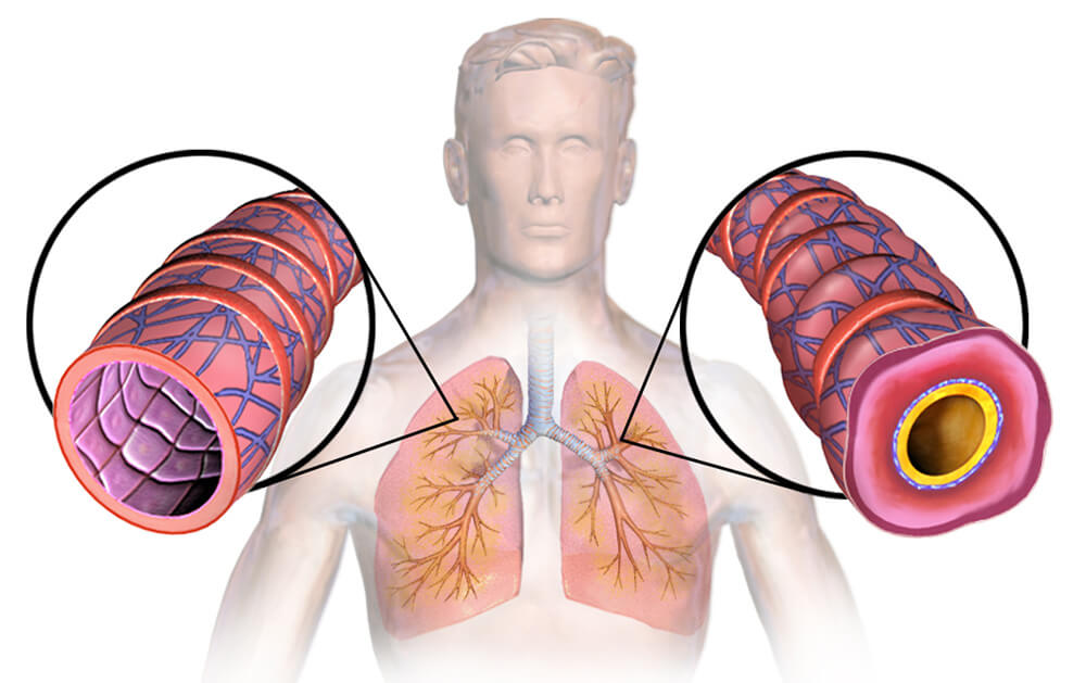 This diagram shows how salt therapy can open our airways, which can particularly helpful for asthma sufferers.